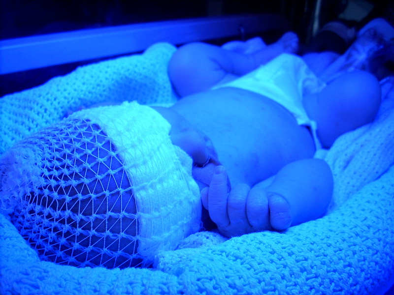 A baby sits under blue light in a phototherapy machine. (Photo by Jim Champion via Flickr/Creative Commons https://flic.kr/p/63WsH9)